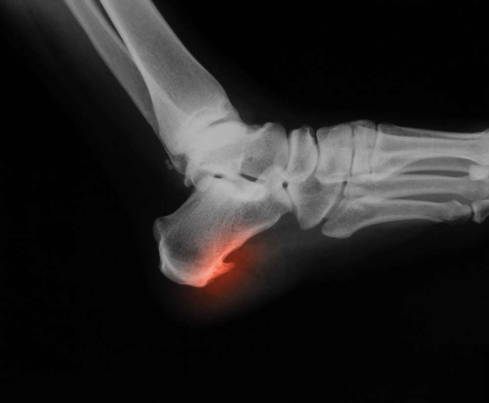 calcaneal spur xray