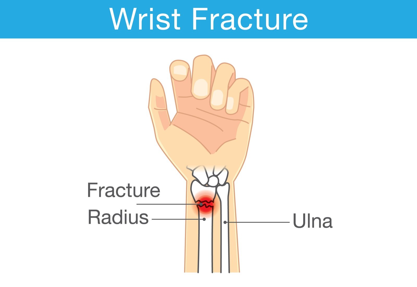 distal radial fracture causes symptoms and treatments