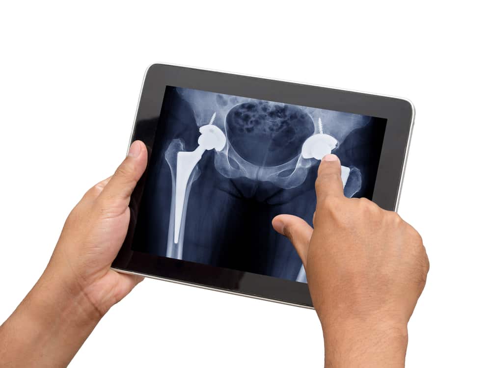 Hip Replacement