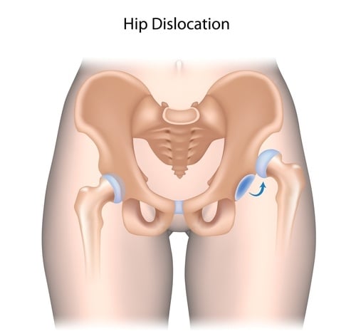 Hip Pain: Causes, Treatment, and Prevention